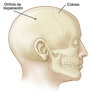 Vista lateral de una cabeza en la que puede verse el cráneo con orificio de trepanación.
