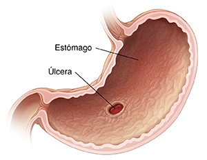 Corte transversal del estómago donde se observa una úlcera en el revestimiento del estómago.