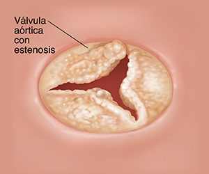 Vista superior de una válvula aórtica abierta con estenosis.