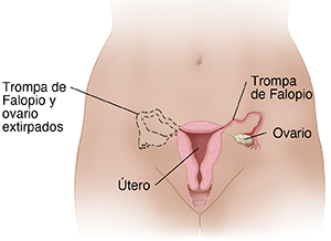 Pelvis femenina donde se observan los órganos reproductores. Las líneas de puntos muestran la extirpación de la trompa de Falopio y del ovario en un lado.