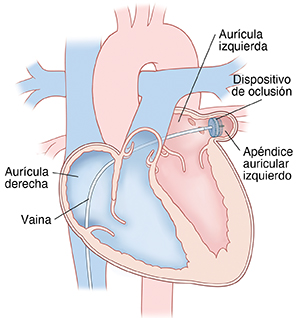 Corte transversal de vista frontal de un corazón con un catéter insertado por medio de la vena cava inferior y a través de ambas aurículas hasta el apéndice auricular izquierdo. El dispositivo de cierre se ubica en el extremo del catéter en el apéndice auricular izquierdo.