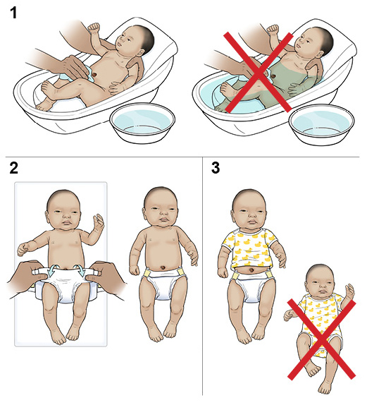 Tres pasos para cuidar el cordón umbilical del recién nacido.