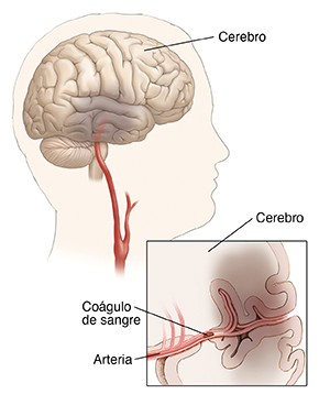 Vista lateral de la cabeza y el cuello en la que se muestra un cerebro que presenta daños. El recuadro muestra el coágulo de sangre alojado en una arteria cerebral.