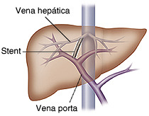Hígado que muestra un stent que conecta la vena porta y la vena hepática.