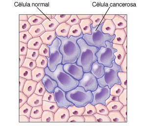 Primer plano de células normales con forma regular, y una masa de células cancerosas grandes con forma anormal ubicada en el centro.