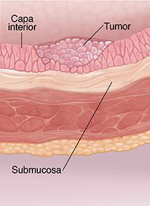 Corte transversal de la pared de la vejiga donde puede verse cáncer en etapa superficial.