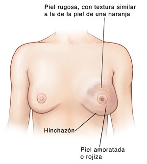 Vista frontal del pecho de una mujer que muestra hinchazón, piel de naranja áspera, enrojecida, y con apariencia amoratada en la mama izquierda. La mama izquierda tiene el pezón invertido. La mama derecha es normal.