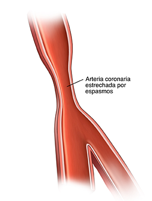 Corte transversal de una arteria estrechada debido a un espasmo.