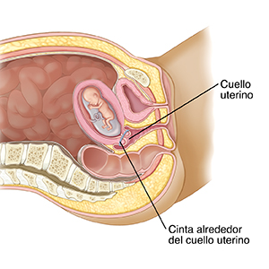 Corte transversal visto de lado de la pelvis de una mujer en donde se ve un bebé en desarrollo en el útero. Se ve una banda alrededor del cuello uterino para mantenerlo cerrado.