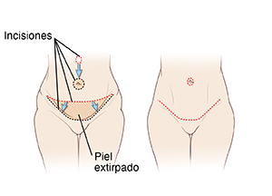 Dos imágenes de un abdomen femenino: la primera imagen muestra las incisiones y el tejido extirpado para la abdominoplastia. La segunda imagen muestra el resultado final de la abdominoplastia.