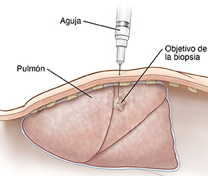 Corte transversal del pecho donde puede verse una aguja que toma una muestra de una zona anómala en el pulmón.