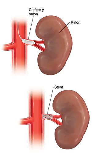 Riñón con globo insertado en la arteria renal. Riñón con stent colocado en la arteria renal.