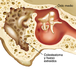 Corte transversal a través del hueso mastoideo y del oído medio que muestra el hueso después de la extracción del colesteatoma.