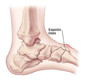 Vista lateral de los huesos de un pie donde se observa espolón óseo en la parte media del pie.