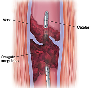 Corte transversal de músculo y vena varicosa con coágulo sanguíneo. Se ve un catéter insertado en la vena a través del coágulo sanguíneo.