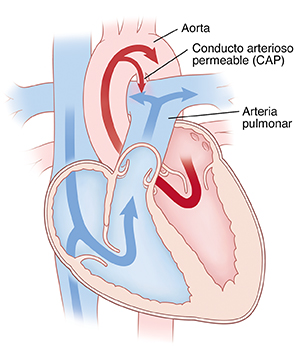 Corte transversal de vista frontal de un corazón que muestra un conducto arterioso permeable que conecta la aorta con la arteria pulmonar. Las flechas muestran que la sangre fluye del ventrículo izquierdo a la aorta y algo de sangre pasa por el CAP a la arteria pulmonar.