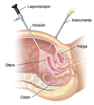 Corte transversal de la pelvis femenina, donde se observa la laparoscopia.