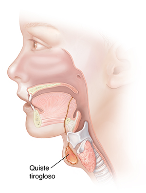 Vista lateral de una cabeza en donde puede verse un quiste tirogloso.