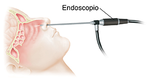 Vista lateral de una cabeza donde pueden verse los senos paranasales y el endoscopio insertado en la nariz.