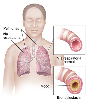 Vista frontal del cuerpo de una mujer en donde se observa el sistema respiratorio. Recuadros donde se observan una vía respiratoria normal y una vía respiratoria con bronquiectasia.