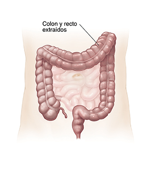 Vista frontal de los intestinos donde pueden verse el colon y el recto resaltados para mostrar la sección que se extirpará.