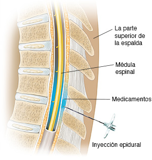 Corte transversal de la columna torácica con una aguja insertada justo fuera del saco alrededor de la médula espinal.