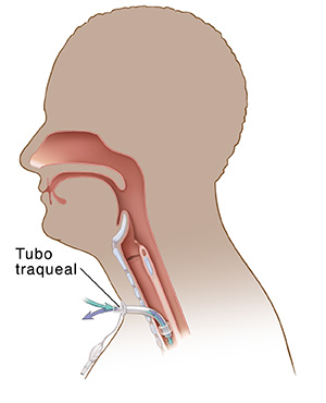 Corte transversal de la cabeza y las vías respiratorias donde puede verse un tubo traqueal con manguito y un tubo piloto.