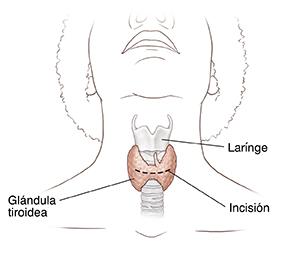 Vista frontal de una cabeza y un cuello donde se ve la glándula tiroidea y el sitio de la incisión.