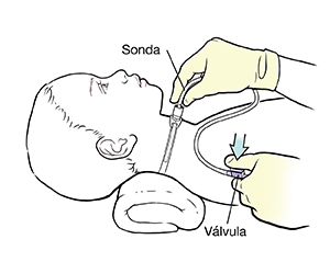 Niño acostado boca arriba con una almohada debajo del cuello. Una mano enguantada está insertando un catéter en un tubo de traqueostomía. Otra mano sostiene el catéter cerca de la válvula.