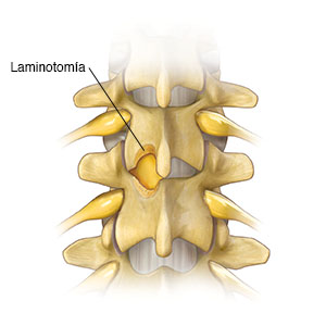 Vista posterior de las vértebras lumbares que muestra la lámina de dos vértebras parcialmente extraída.