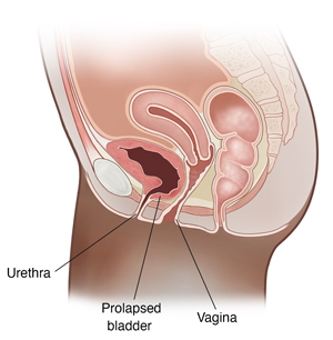 Seccion transversal de vista lateral de la pelvis femenina que muestra vejiga prolapsada (cistocele).