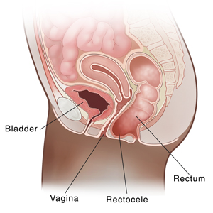 La sección transversal de la pelvis femenina con vista lateral muestra que el recto se hunde en la vagina (rectocele).