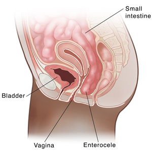 Seccion transversal de vista lateral de la pelvis femenina en la que se muestra el intestino delgado prolapsado (enterocele).