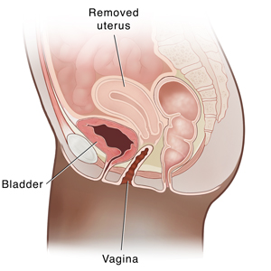 Seccionamiento transversal de la pelvis femenina con vista lateral que muestra una histerectomía.