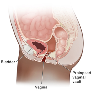 La sección transversal lateral de la pelvis femenina muestra prolapso de la bóveda vaginal.