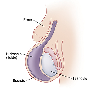 Primer plano del pene de un bebé en donde se ve un testículo dentro del escroto. Hay un saco grande de líquido (hidrocele) dentro del escroto que lo agranda.