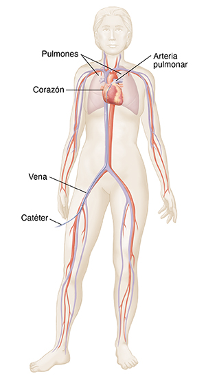 Vista frontal de un contorno de mujer en el que pueden verse el corazón, los pulmones, las venas y arterias principales. Se ve un catéter insertado en la vena femoral que va hasta el corazón.