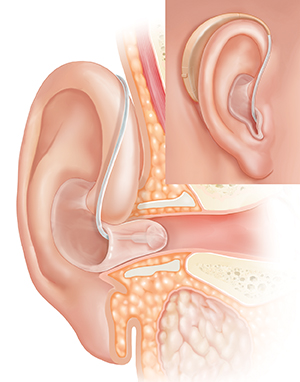 Corte transversal de un oído, donde pueden verse las estructuras del oído externo, interno y medio, con un audífono colocado detrás de la oreja y un recuadro que muestra la vista externa.