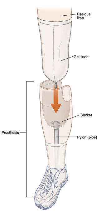 All the parts of a leg prosthesis.