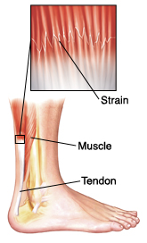 Side view of lower leg showing leg and heel bones, muscle, and tendon. Closeup shows strain (damage) in muscle near tendon.