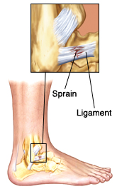 Side view of lower leg showing leg and heel bones and ligaments. Closeup shows sprain (damage) in ligament.
