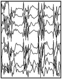 Generalized seizure EEG tracing.