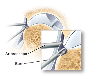 Closeup of arthroscope tip in hip joint and burr removing excess bone.