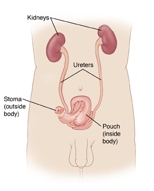 Front view of male outline showing kidneys, ureters, and neobladder with stoma to outside of body.