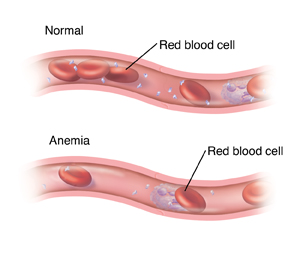 Normal blood vessel with red blood cells and other blood components, compared to a blood vessel with low red blood cells due to anemia.