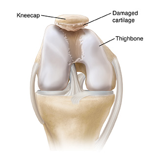 Front view of bent knee joint showing cartilage damage.