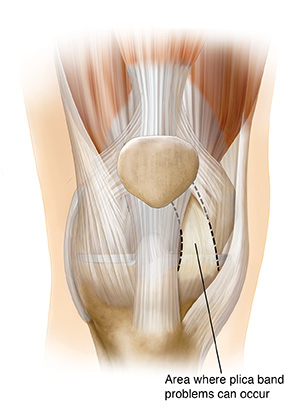 Front view of knee joint showing plica band.