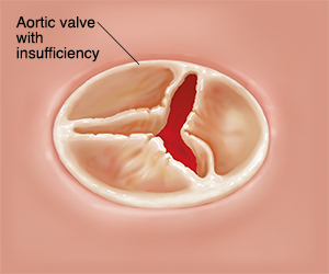 Top view of closed aortic valve with insufficiency.