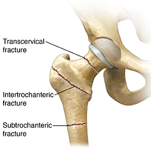 Front view of hip joint showing three types of hip fractures.