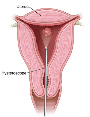 Cross section of uterus showing hysteroscopy.